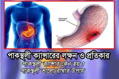 পাকস্থলী ক্যান্সারের লক্ষণ ও প্রতিকার