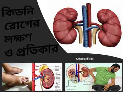 কিডনি রোগের লক্ষণ ও প্রতিকার